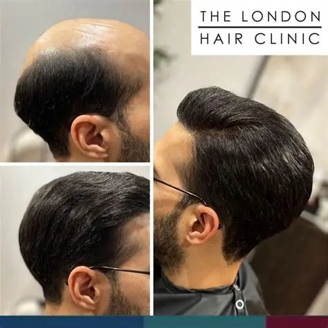 بروكة شعر